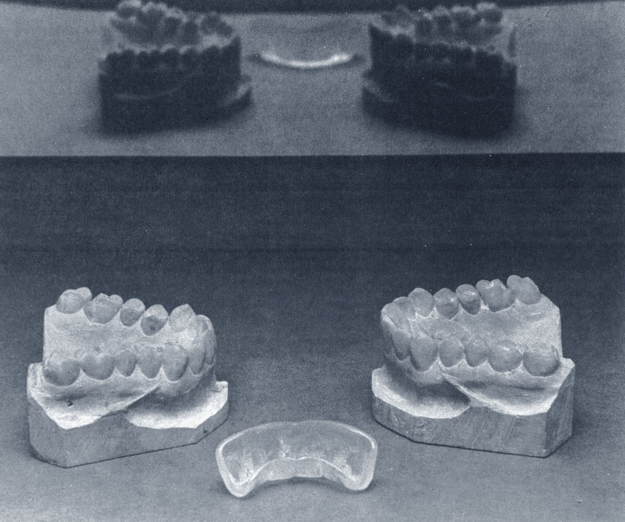 Plastic overlay shown in foreground. Model on left is patient before porcelain crowns - Model on right is after crowns