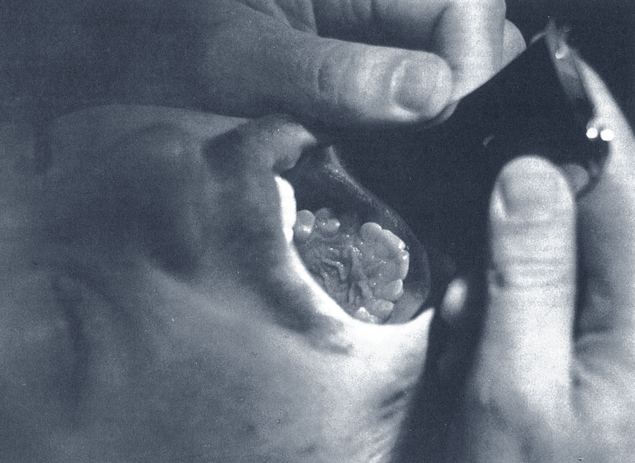 Anterior teeth (reflected in mirror) showing “wedge” shape after bonding