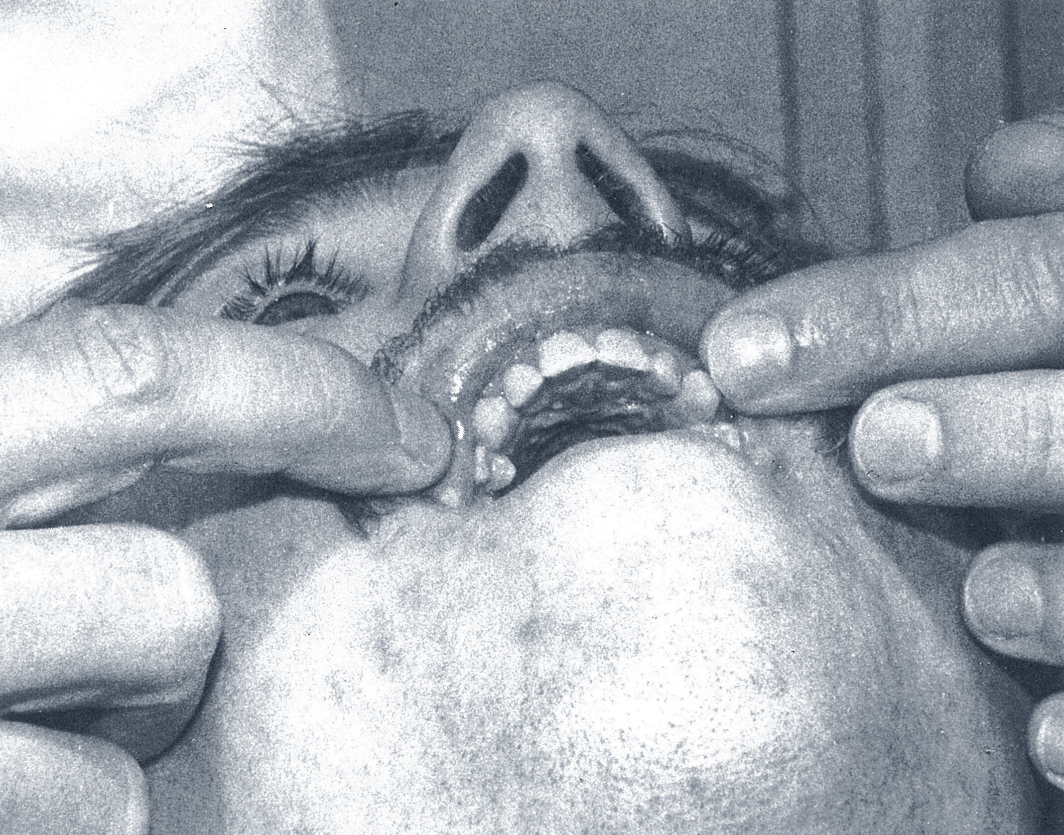 Anterior teeth before bonding
