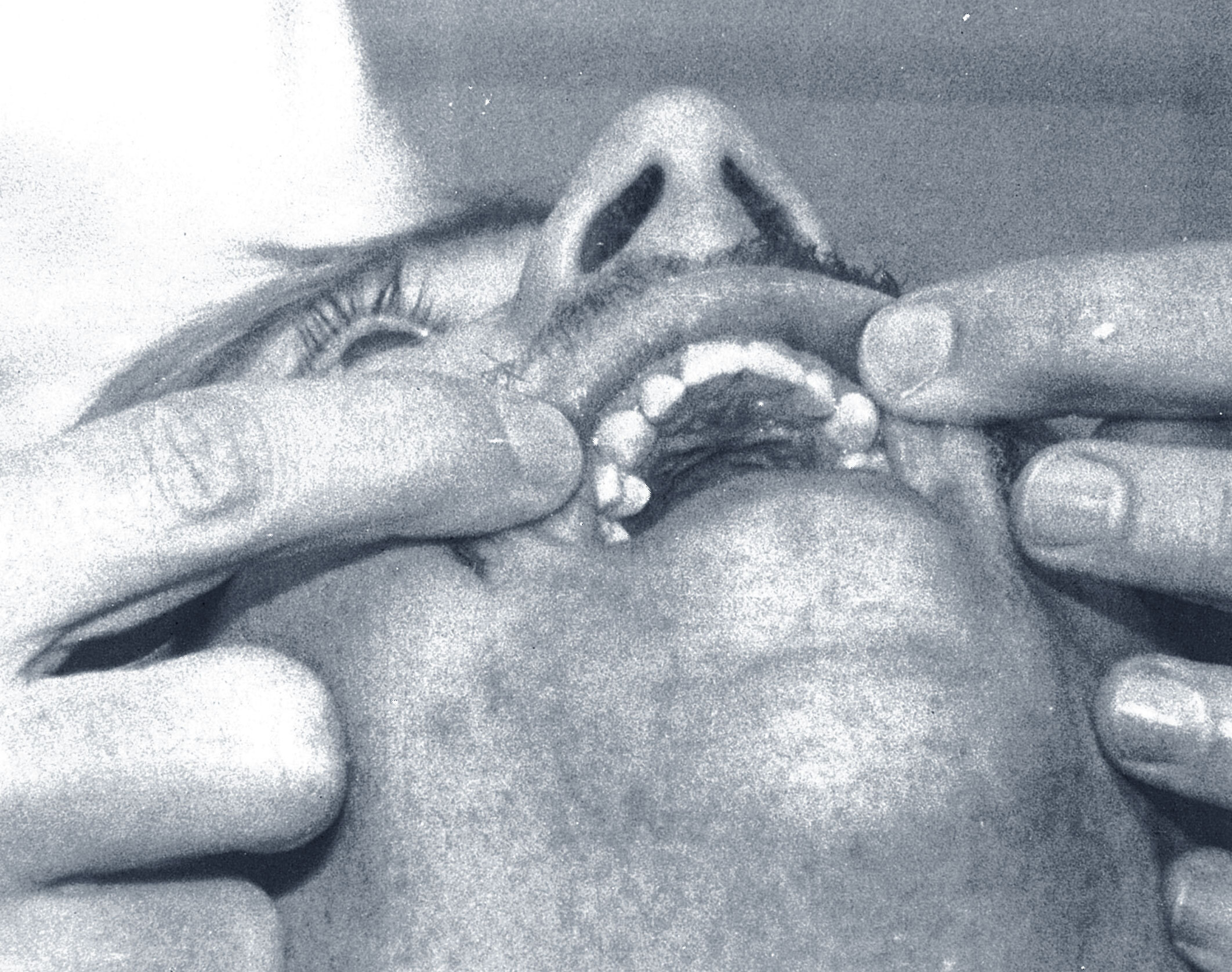 Anterior teeth after bonding